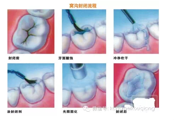 口腔窩溝封閉，就如同給牙齒穿上了一層保護衣，使牙齒免受食物侵蝕。原理：窩溝封閉后，窩溝內(nèi)原有的細菌斷。