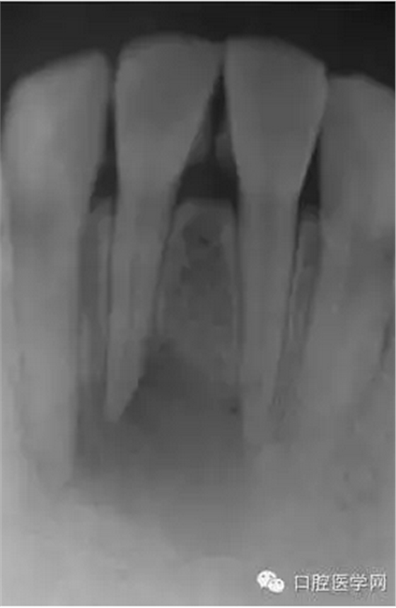 常規(guī)根管治療成功處理根尖周病變較大牙齒