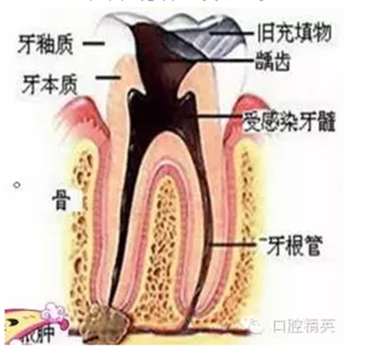 根管治療