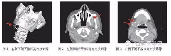 	下頜下靜脈畸形伴多發靜脈石誤診為涎石病1例