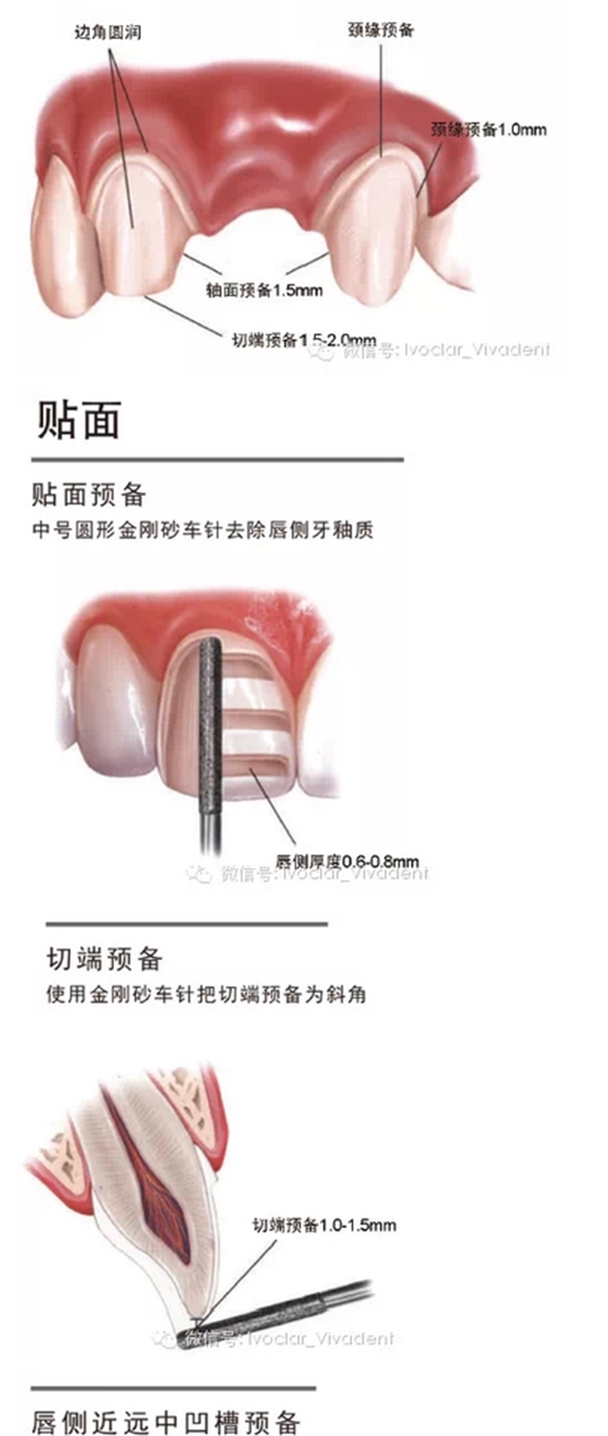 時常搞不清楚怎么備牙嗎？義獲嘉教您如何完美備牙