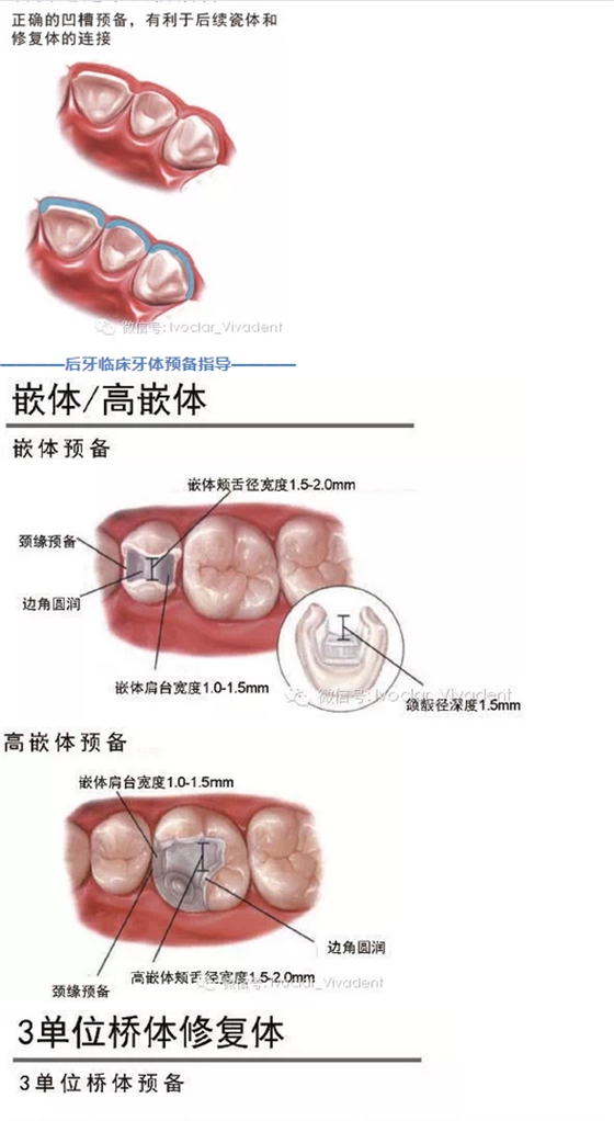 時常搞不清楚怎么備牙嗎？義獲嘉教您如何完美備牙