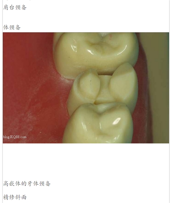 嵌體牙體預備方法