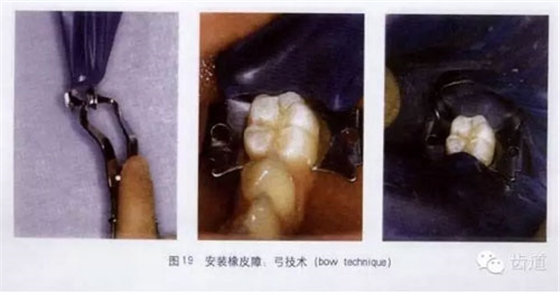 橡皮障的臨床運用大全