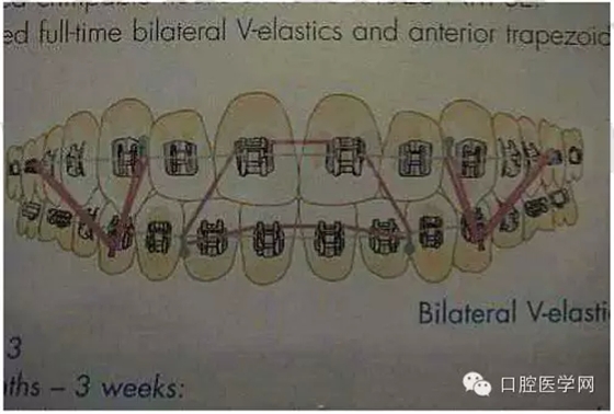 正畸damon system橡皮筋(elastics)掛法示意圖