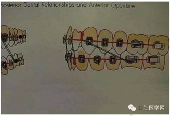 正畸damon system橡皮筋(elastics)掛法示意圖