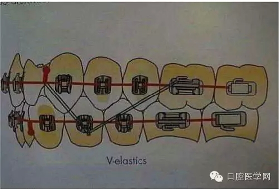 正畸damon system橡皮筋(elastics)掛法示意圖