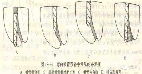 根管治療的并發癥及處理