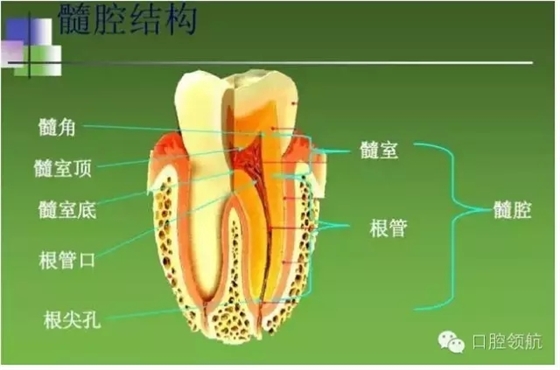 開髓術