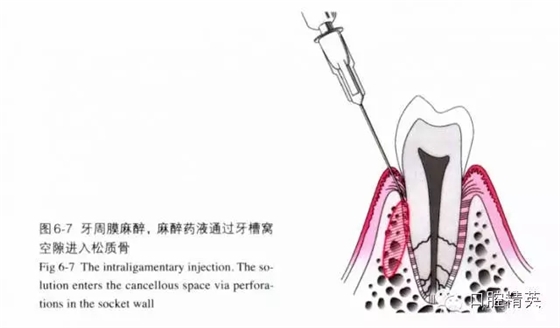 分析局部麻醉失敗的常見原因