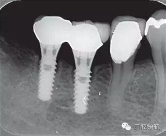 種植體周圍出現伴有骨密度增加現象的骨吸收