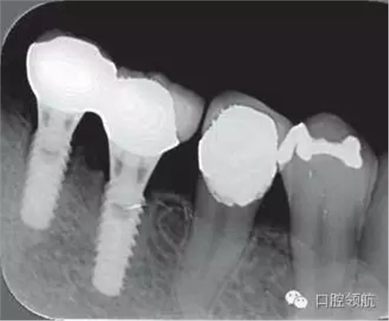 種植體周圍出現伴有骨密度增加現象的骨吸收