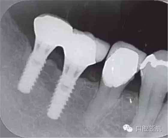 種植體周圍出現伴有骨密度增加現象的骨吸收