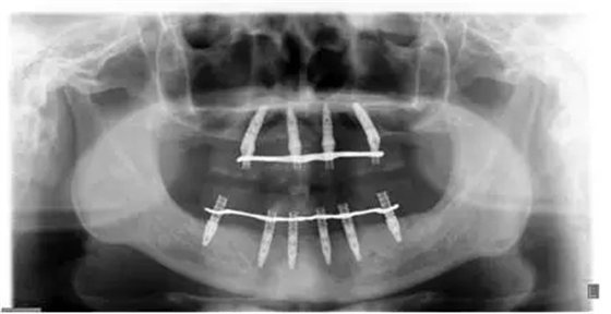 All-on-4上頜種植失敗一例及處理方法解析 