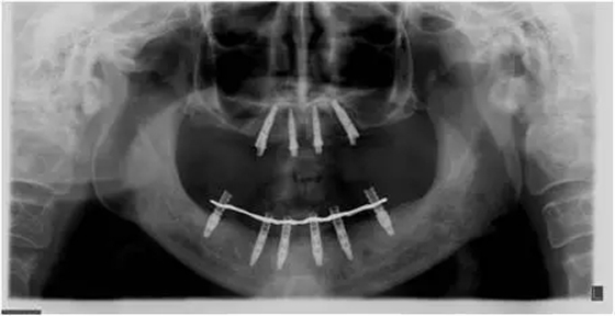 All-on-4上頜種植失敗一例及處理方法解析 