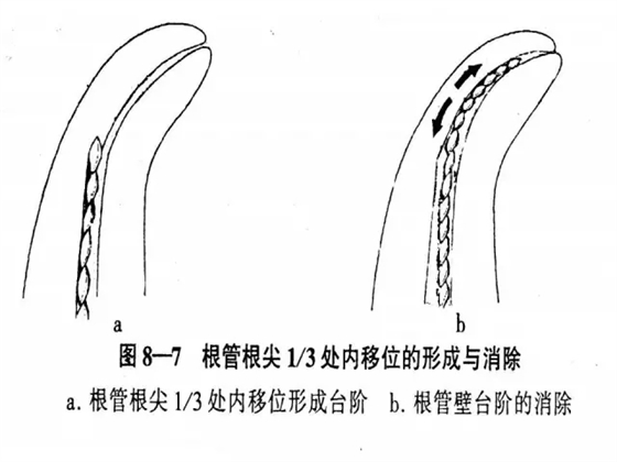 根管治療并發癥及處理