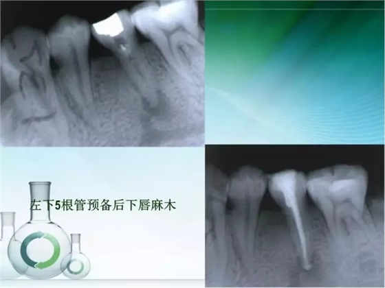 根管治療并發癥及處理