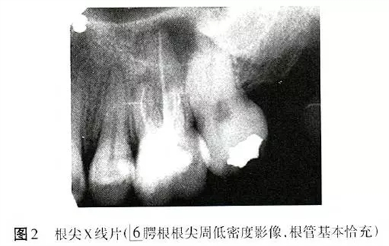 根管治療