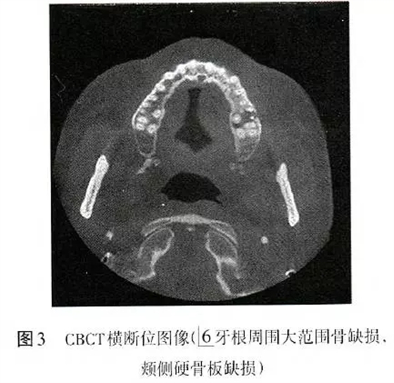 根管治療