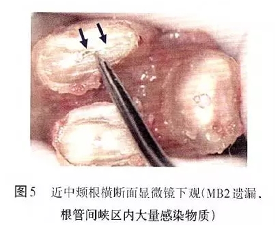 根管治療