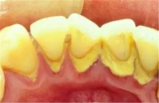牙結(jié)石——不可掉以輕心的口腔"惡魔"