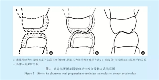 王美青.淺談咬合修復重建中的（牙合）學問題