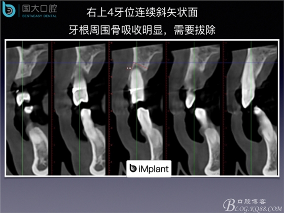 上頜竇底區域嚴重骨吸收的臨床種植案例.jpeg