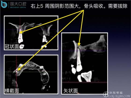 上頜竇底區域嚴重骨吸收的臨床種植案例.jpeg