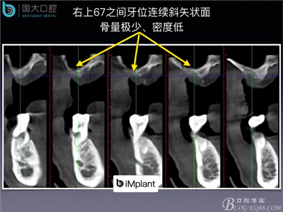 上頜竇底區域嚴重骨吸收的臨床種植案例.jpeg