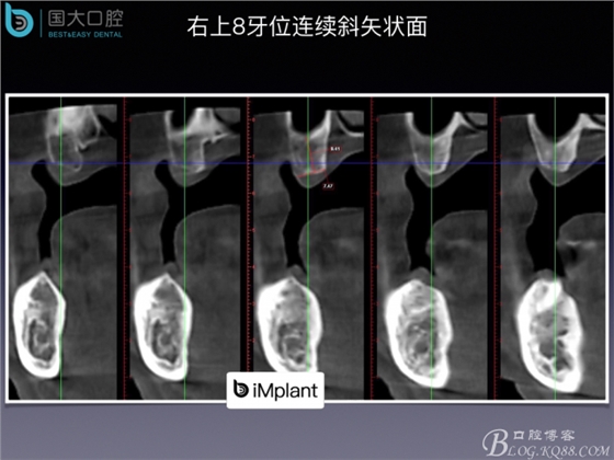 上頜竇底區域嚴重骨吸收的臨床種植案例.jpeg