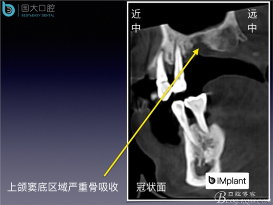 上頜竇底區域嚴重骨吸收的臨床種植案例.jpeg