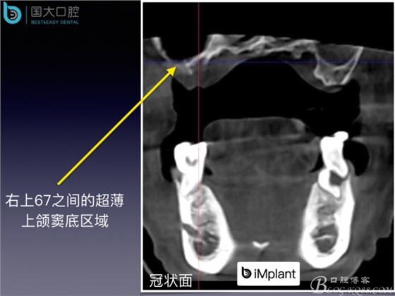 上頜竇底區域嚴重骨吸收的臨床種植案例.jpeg