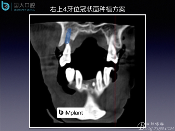 上頜竇底區域嚴重骨吸收的臨床種植案例.jpeg