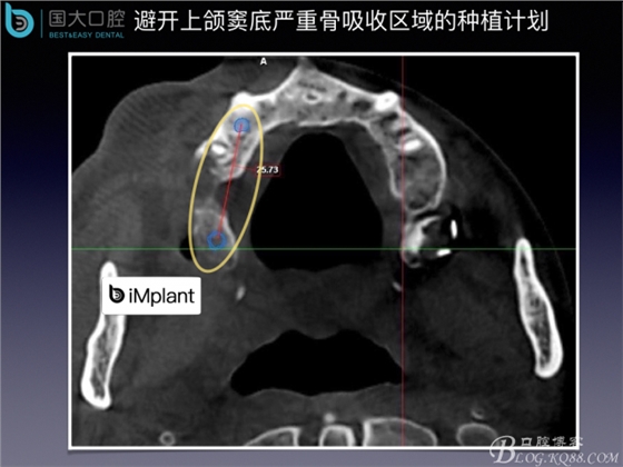 上頜竇底區域嚴重骨吸收的臨床種植案例.jpeg