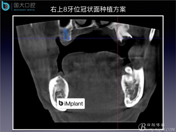 上頜竇底區域嚴重骨吸收的臨床種植案例.jpeg