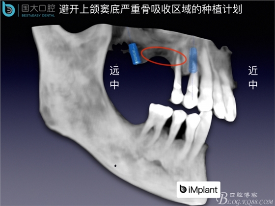 上頜竇底區域嚴重骨吸收的臨床種植案例.jpeg