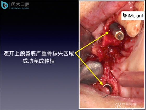 上頜竇底區域嚴重骨吸收的臨床種植案例.jpeg