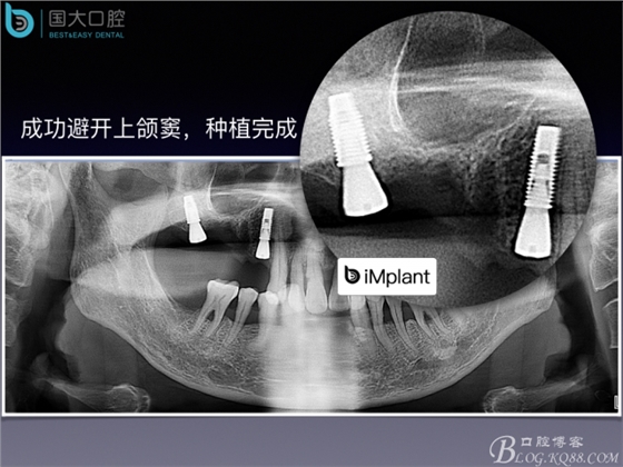 上頜竇底區域嚴重骨吸收的臨床種植案例.jpeg