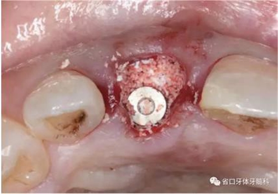 右上前牙即刻種植即刻修復(fù)1例