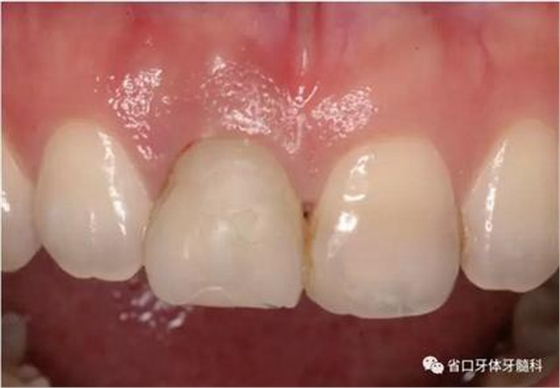 右上前牙即刻種植即刻修復(fù)1例