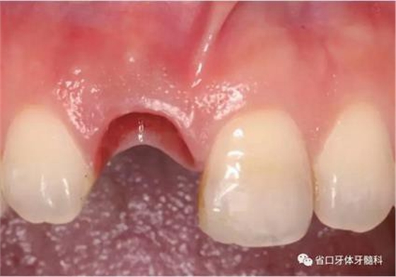右上前牙即刻種植即刻修復(fù)1例