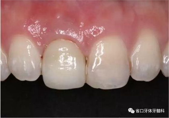 右上前牙即刻種植即刻修復(fù)1例