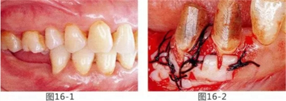 FGG法增大附著齦及根面覆蓋【牙齦－牙槽黏膜的問題】