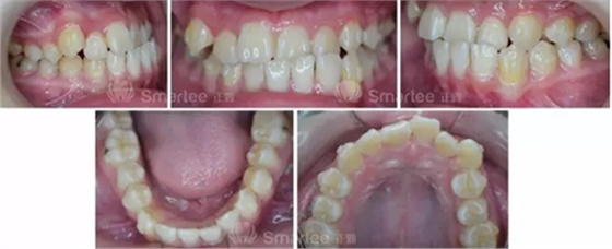 【病例展示】Smartee隱形正畸中國好病例鑒賞第三波