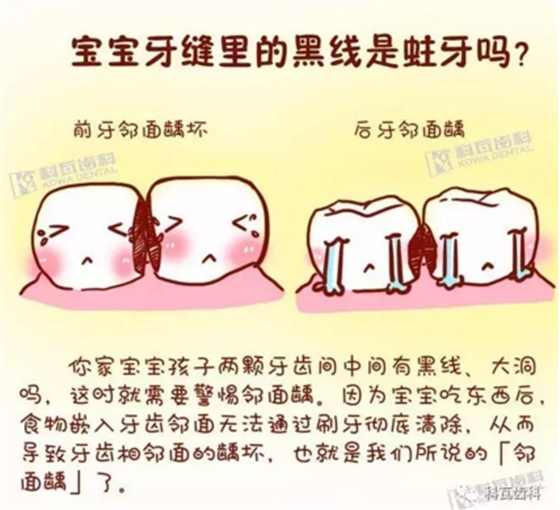 牙縫間的黑線是鄰面齲，還一壞壞倆，巧用它幫你渡過一“劫”