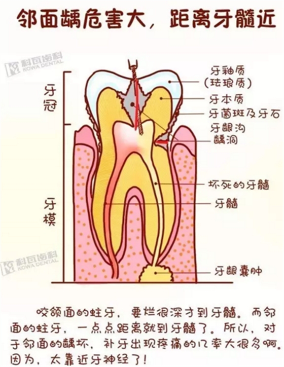 牙縫間的黑線是鄰面齲，還一壞壞倆，巧用它幫你渡過一“劫”