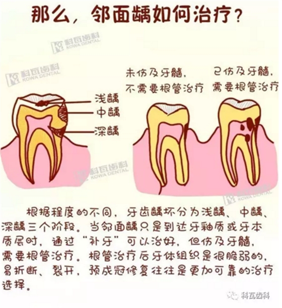 牙縫間的黑線是鄰面齲，還一壞壞倆，巧用它幫你渡過一“劫”