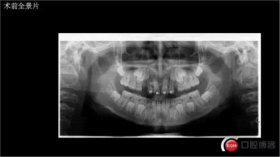 CBCT導航下多生牙拔除，混合牙列期矯正思考！