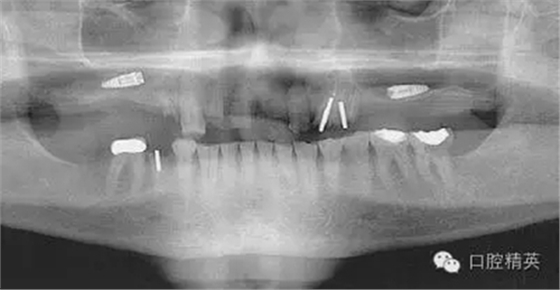 口腔種植各種失敗模式的病因探查