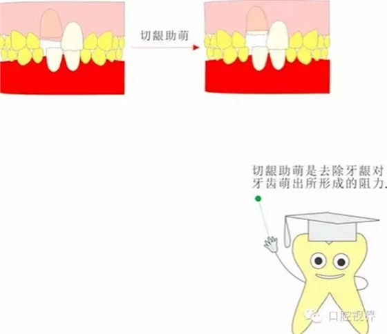  “什么是牙周袋沖洗？”